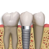 Implanturi dentare